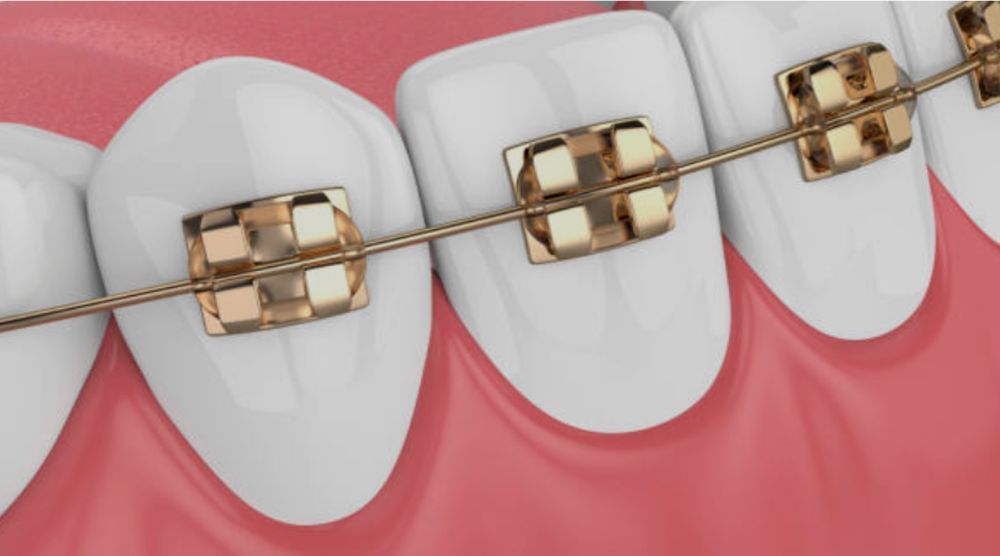 archi-di-ortodonzia-tipi-e-funzioni